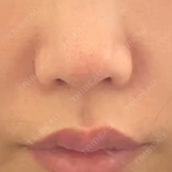 鼻翼基部形成（貴族手術） ジョウクリニック 大阪院 DAY 3 メイン用