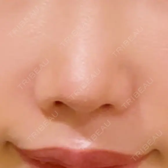 鼻翼基部形成（貴族手術） ジョウクリニック 大阪院 AFTER メイン用