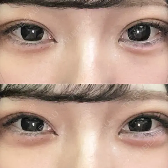 ヒアルロン酸注入（涙袋） / ボトックス（タレ目） アネシス美容クリニック DAY 0 メイン用