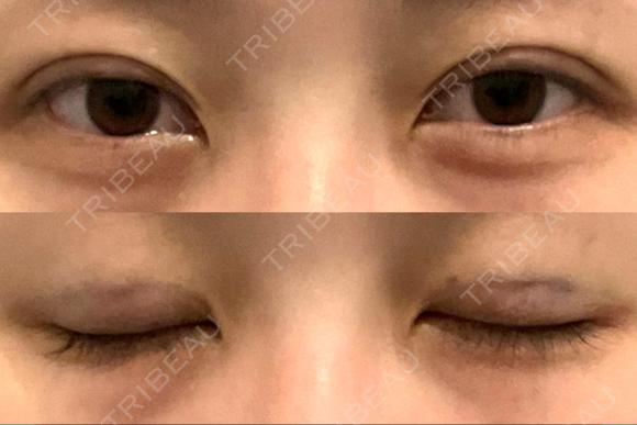 二重埋没 アリエル美容クリニック 郡山院 DAY 0 メイン用