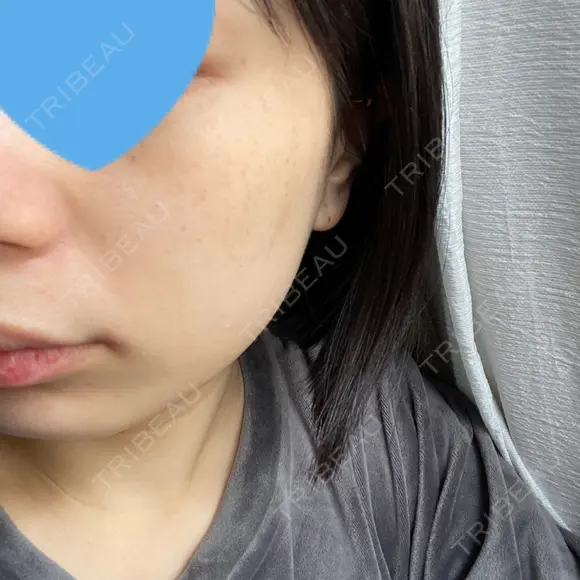 光治療（フォトフェイシャルなど） 椿クリニック 名古屋院 DAY 10 メイン用