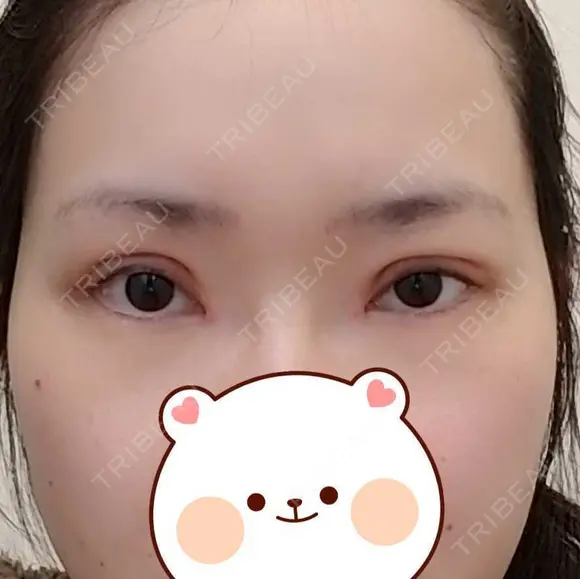 二重切開 / 目頭切開 / 眼瞼下垂（切開） / 目元修正 聖心美容クリニック 札幌院 DAY 21 メイン用