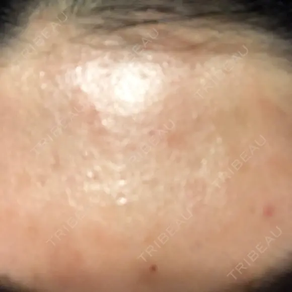 ダーマペン LIFIX BEAUTY CLINIC DAY 2 メイン用