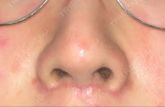 骨切り（あご） / 骨削り（エラ） / 骨削り（頬） リラ・クラニオフェイシャル・クリニック AFTER メイン用