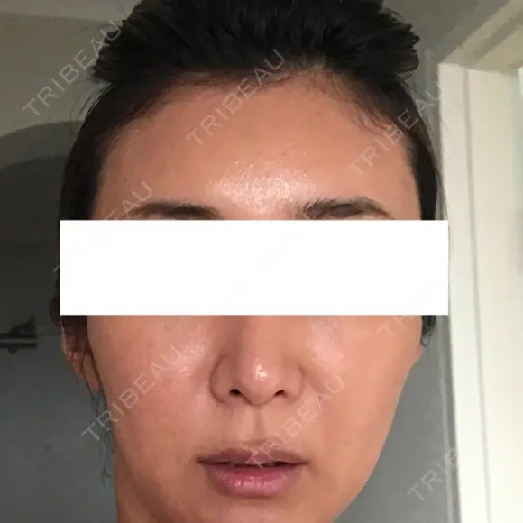その他（輪郭） / 輪郭修正 ニューセンス皮膚科クリニック DAY 7 メイン用