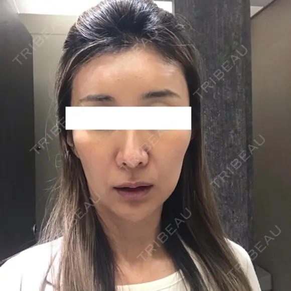 その他（輪郭） / 輪郭修正 ニューセンス皮膚科クリニック DAY 21 メイン用