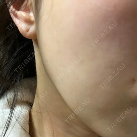 ピーリング（ニキビ・毛穴） まゆりなclinic 名古屋栄 DAY 0 メイン用