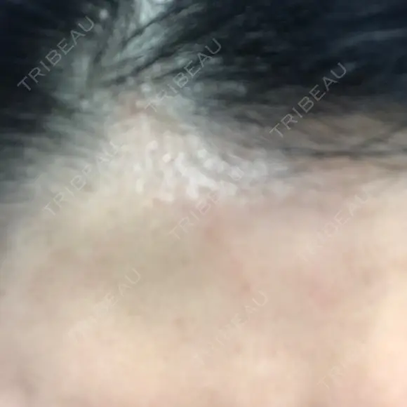 ダーマペン LIFIX BEAUTY CLINIC DAY 5 メイン用