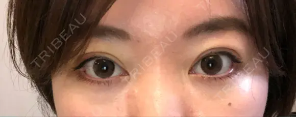 二重埋没 / 上まぶたの脂肪取り アリエル美容クリニック 郡山院 DAY 4 メイン用