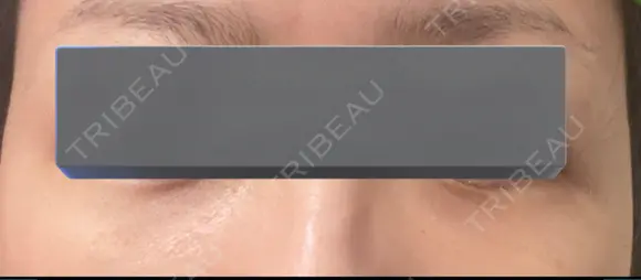 下まぶたの脂肪取り BRIGHTS beauty clinic AFTER メイン用