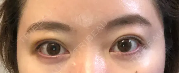 二重埋没 / 上まぶたの脂肪取り アリエル美容クリニック 郡山院 DAY 5 メイン用