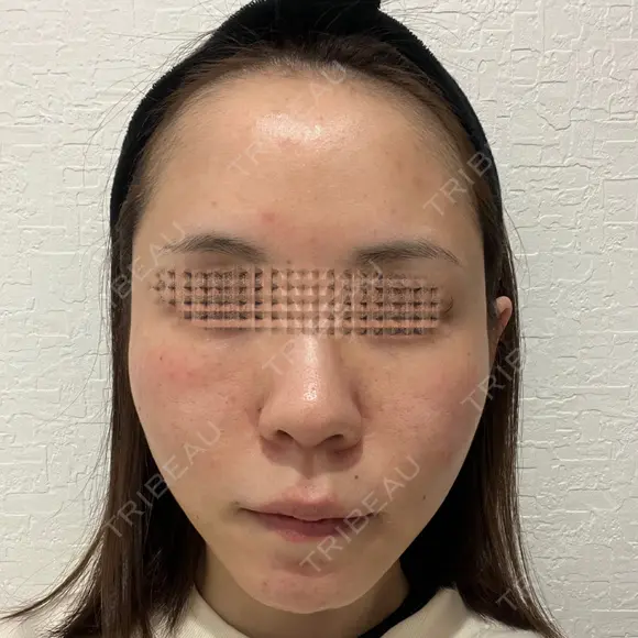 額を丸く / 脂肪注入（肌） / 脂肪注入（額） / 脂肪注入（輪郭） EMMA CLINIC（エマクリニック） DAY 31 メイン用