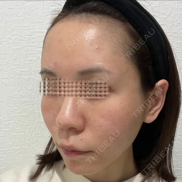 額を丸く / 脂肪注入（肌） / 脂肪注入（額） / 脂肪注入（輪郭） EMMA CLINIC（エマクリニック） DAY 31 メイン用