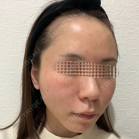 額を丸く / 脂肪注入（肌） / 脂肪注入（額） / 脂肪注入（輪郭） EMMA CLINIC（エマクリニック） DAY 31 メイン用