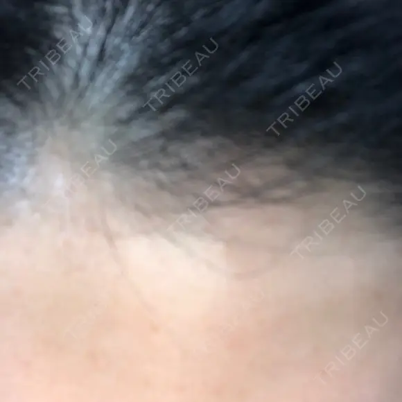 ダーマペン LIFIX BEAUTY CLINIC AFTER メイン用