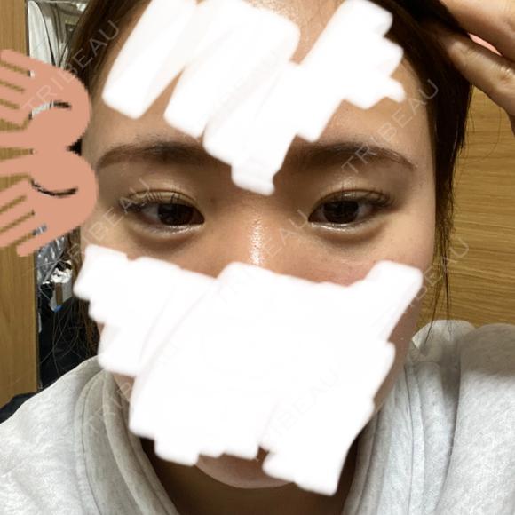 クマ治療 NARU Beauty Clinic 【ナルクリ】 DAY 10 メイン用
