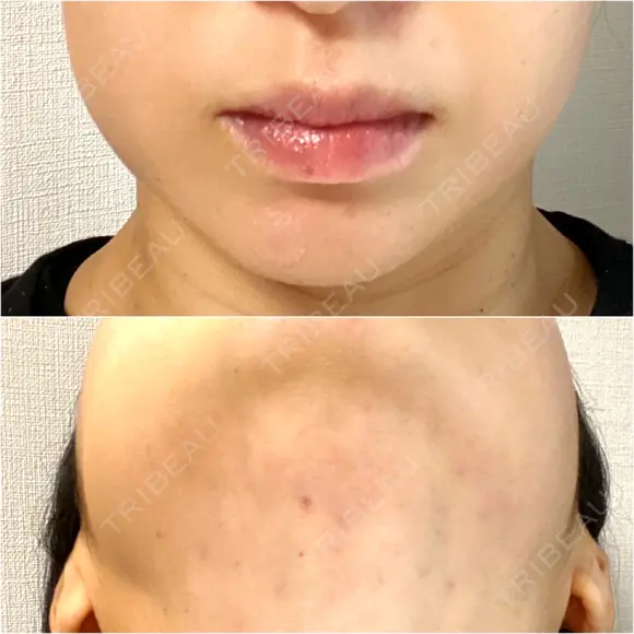 ボトックス（エラ・小顔） / 脂肪溶解注射（顔） / 脂肪溶解注射 渋谷美容外科クリニック 渋谷院 AFTER メイン用