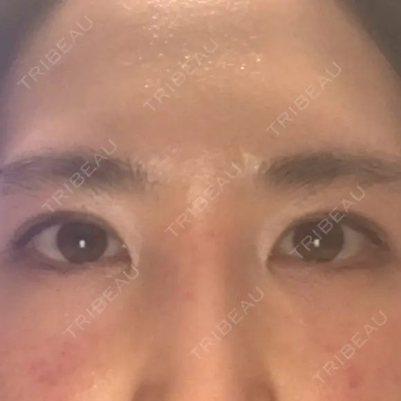 二重埋没 アリエル美容クリニック 郡山院 DAY 24 メイン用