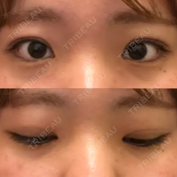二重埋没 湘南美容クリニック 大阪心斎橋院 DAY 74 メイン用