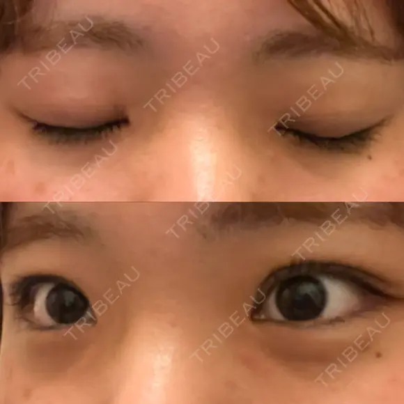 二重埋没 湘南美容クリニック 大阪心斎橋院 DAY 74 メイン用