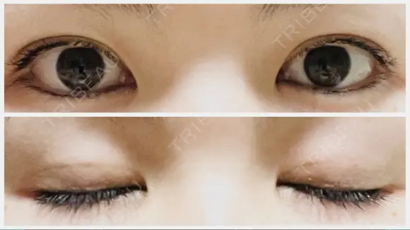 二重埋没 アリエル美容クリニック 郡山院 DAY 20 メイン用