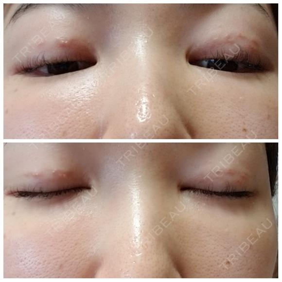二重埋没 アロマ美容外科クリニック DAY 17 メイン用