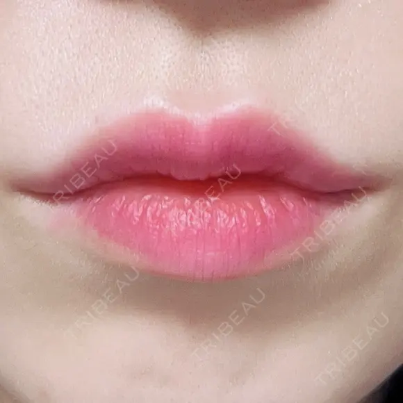 ヒアルロン酸注入（唇） TCB東京中央美容外科 梅田茶屋町院 AFTER メイン用