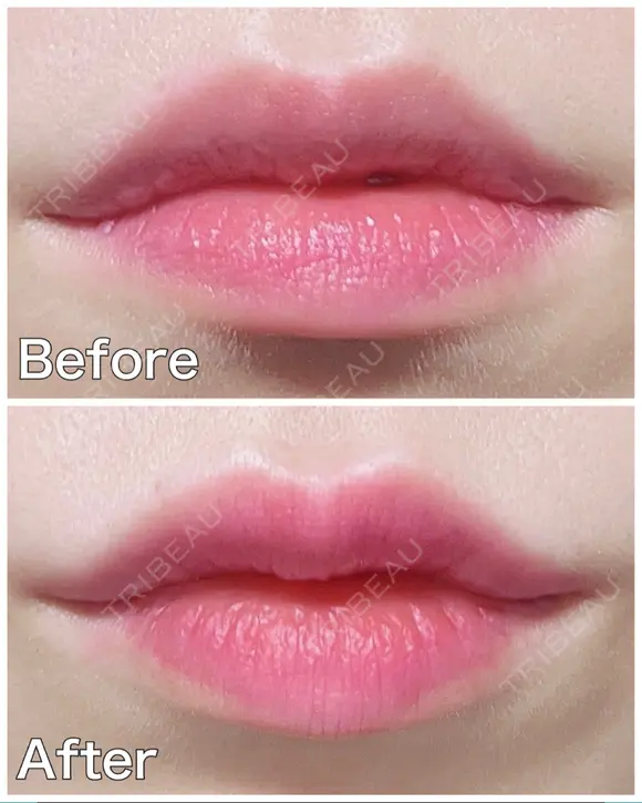 ヒアルロン酸注入（唇） TCB東京中央美容外科 梅田茶屋町院 DAY 0 メイン用