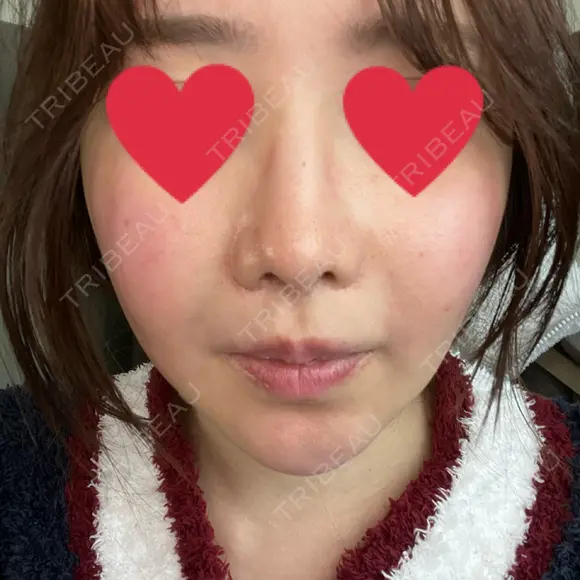 鼻翼基部形成（貴族手術） 新宿ラクル美容外科クリニック 新宿院 DAY 2 メイン用