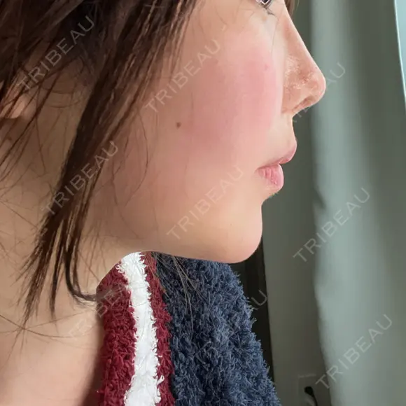 鼻翼基部形成（貴族手術） 新宿ラクル美容外科クリニック 新宿院 DAY 2 メイン用