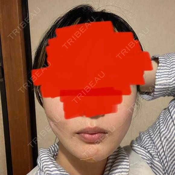 糸リフト / 脂肪吸引（顔） / 傷跡修正 WOM CLINIC GINZA （ワム クリニック ギンザ） AFTER メイン用