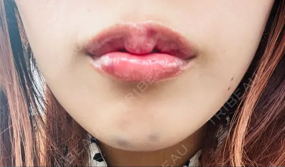 ボトックス（あご） / ヒアルロン酸注入（唇） BELINDA CLINIC（ベリンダクリニック）新宿院 DAY 1 メイン用