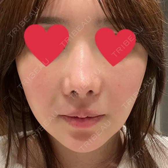 鼻翼基部形成（貴族手術） 新宿ラクル美容外科クリニック 新宿院 DAY 3 メイン用