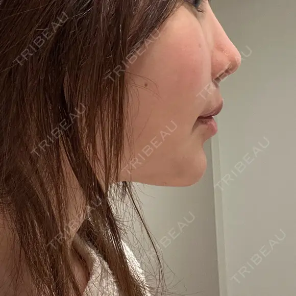 鼻翼基部形成（貴族手術） 新宿ラクル美容外科クリニック 新宿院 DAY 3 メイン用