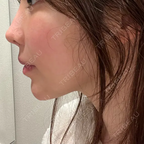 鼻翼基部形成（貴族手術） 新宿ラクル美容外科クリニック 新宿院 DAY 3 メイン用