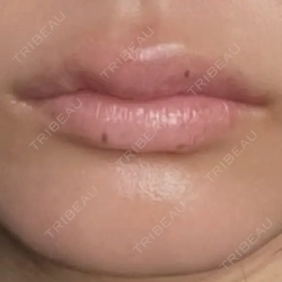 ヒアルロン酸注入（涙袋） / 肌ヒアルロン酸注入（たるみ・シワ改善） / ヒアルロン酸注入（唇） / ヒアルロン酸注入（額） / ヒアルロン酸注入（頬） LA CLEF CLINIC（ラクレクリニック） AFTER メイン用