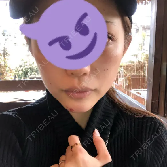 あごプロテーゼ 湘南美容クリニック 池袋西口院 DAY 10 メイン用