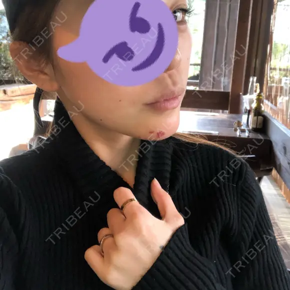 あごプロテーゼ 湘南美容クリニック 池袋西口院 DAY 10 メイン用