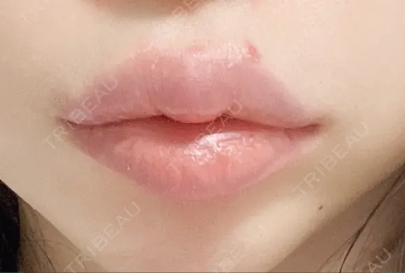 ヒアルロン酸注入（唇） 湘南美容クリニック 大阪堺東院 DAY 7 メイン用