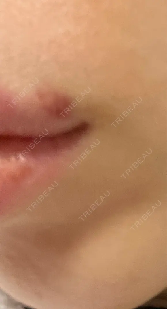 ヒアルロン酸注入（唇） 湘南美容クリニック 大阪堺東院 DAY 7 メイン用