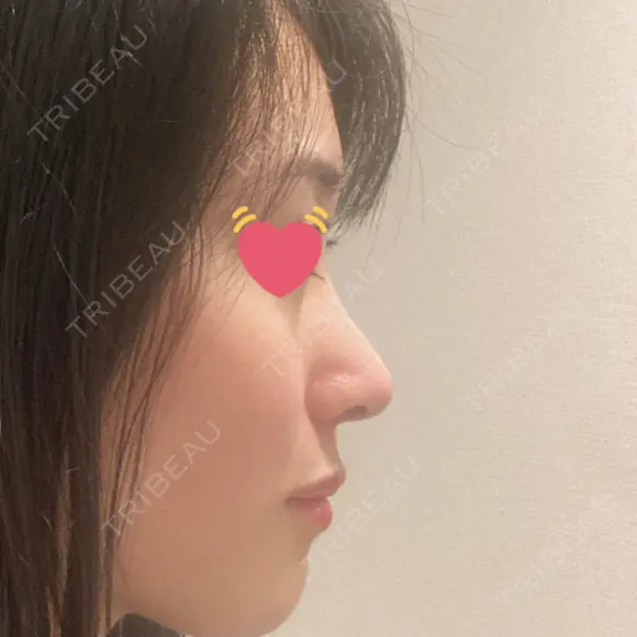 鼻尖形成（切開） / 鼻中隔延長（切開） / 小鼻縮小（切開） / 軟骨移植 / 骨切幅寄せ / ワシ鼻修正・ハンプ切除 / 鼻尖縮小 HANABI整形外科 DAY 116 メイン用