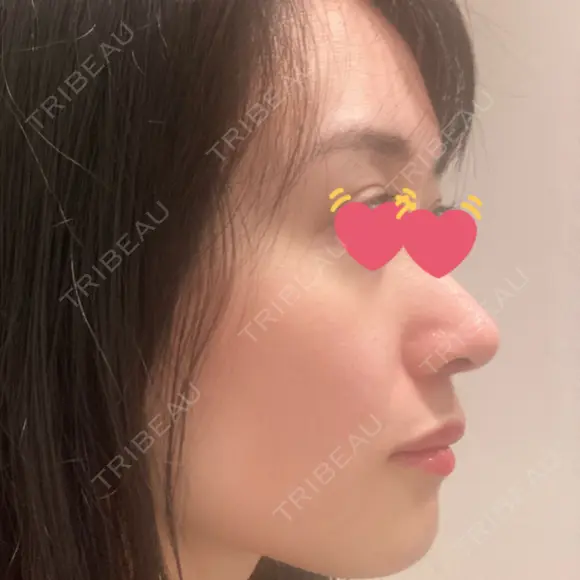 鼻尖形成（切開） / 鼻中隔延長（切開） / 小鼻縮小（切開） / 軟骨移植 / 骨切幅寄せ / ワシ鼻修正・ハンプ切除 / 鼻尖縮小 HANABI整形外科 AFTER メイン用