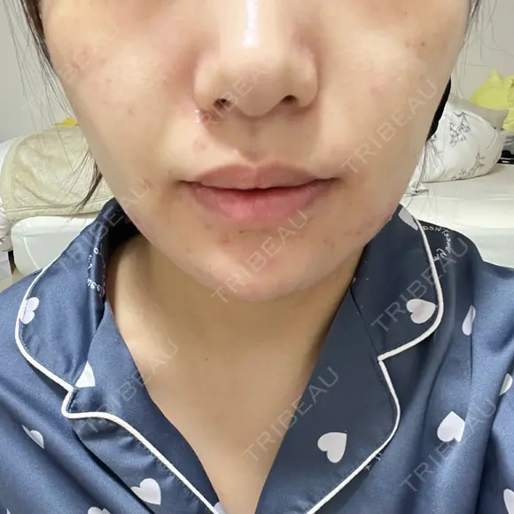 糸リフト / バッカルファット除去 / 脂肪吸引（顔） 湘南美容クリニック 京都院 DAY 102 メイン用