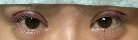 二重切開 LIKI CLINIC KOBE AFTER メイン用