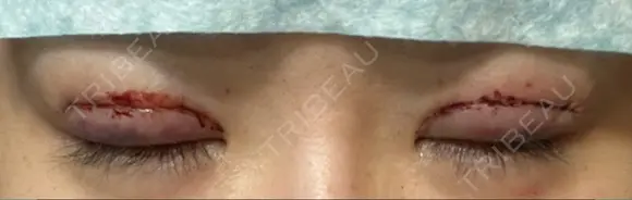 二重切開 LIKI CLINIC KOBE DAY 0 メイン用