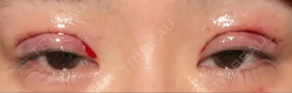 二重切開 LIKI CLINIC KOBE DAY 0 メイン用