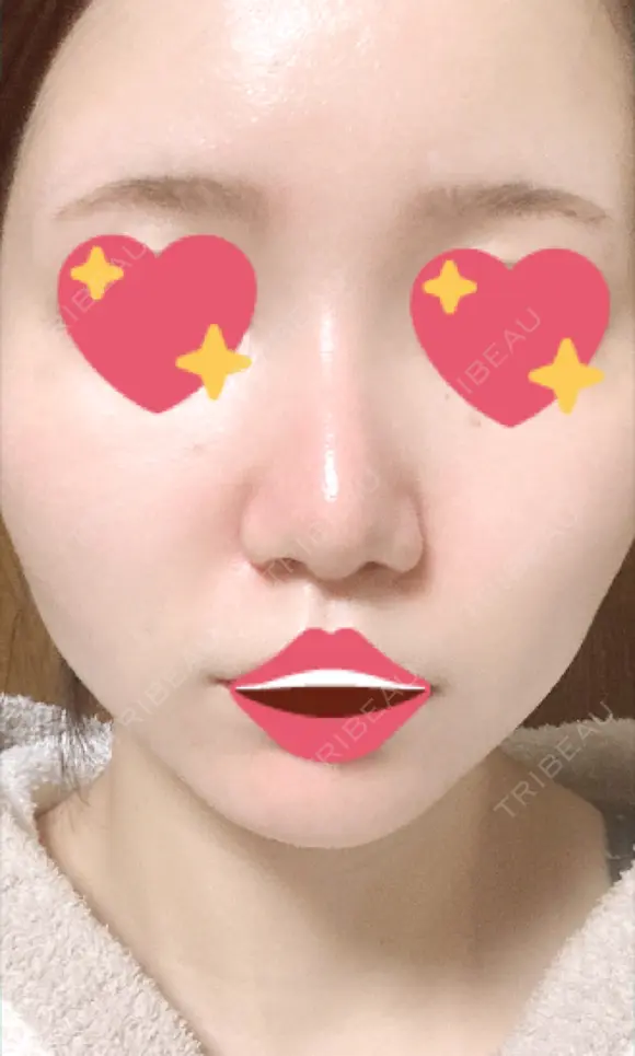 隆鼻術 / 軟骨移植 フェアクリニック川口 AFTER メイン用