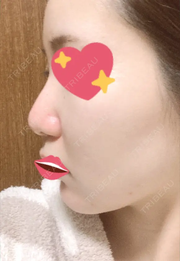 隆鼻術 / 軟骨移植 フェアクリニック川口 DAY 109 メイン用