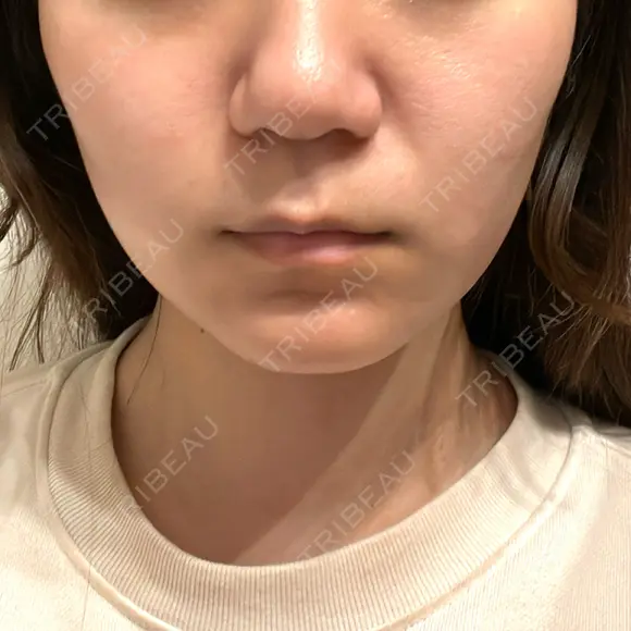 ポテンツァ レナータクリニック 立川院 DAY 1 メイン用