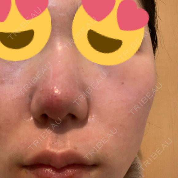 その他（肌） / ポテンツァ LOUIS CLINIC 二子玉川院【ルイクリニック】 DAY 0 メイン用